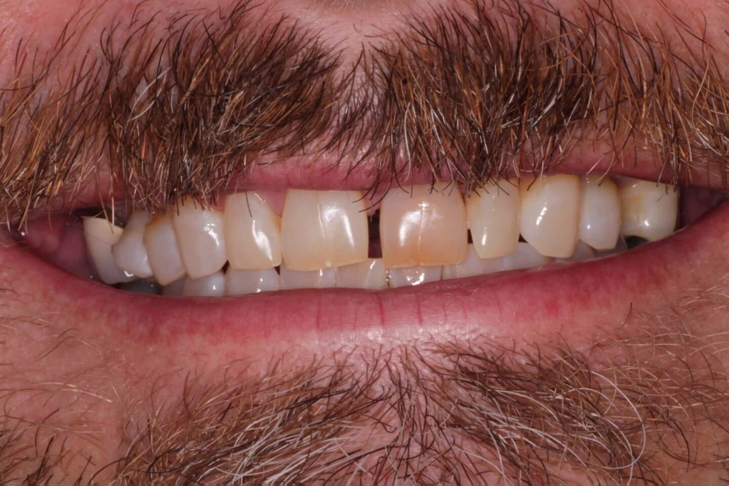 Image result for gap teeth 