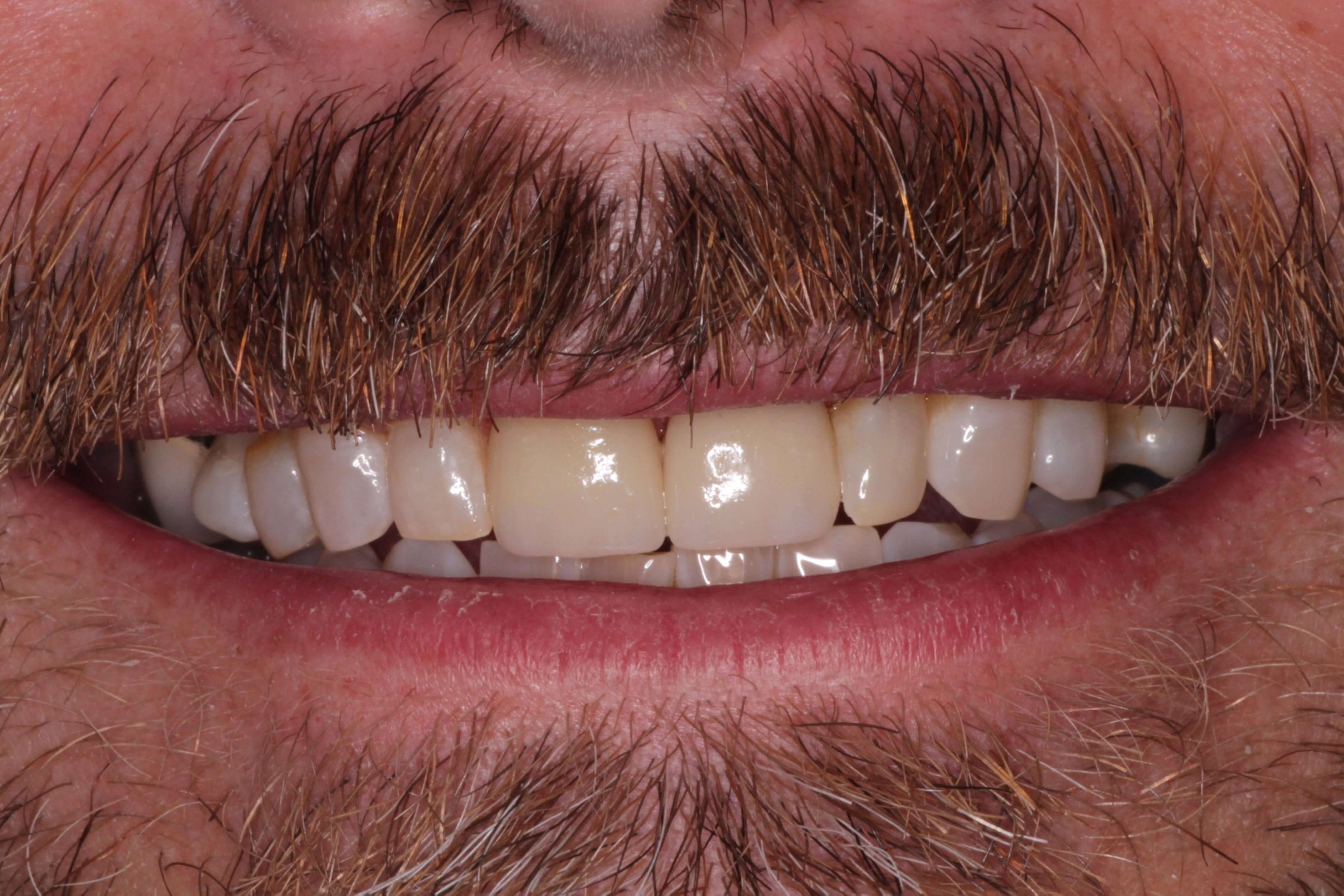 Teeth Whitening & Veneers | Cosmetic Dental | Faber Dental ...